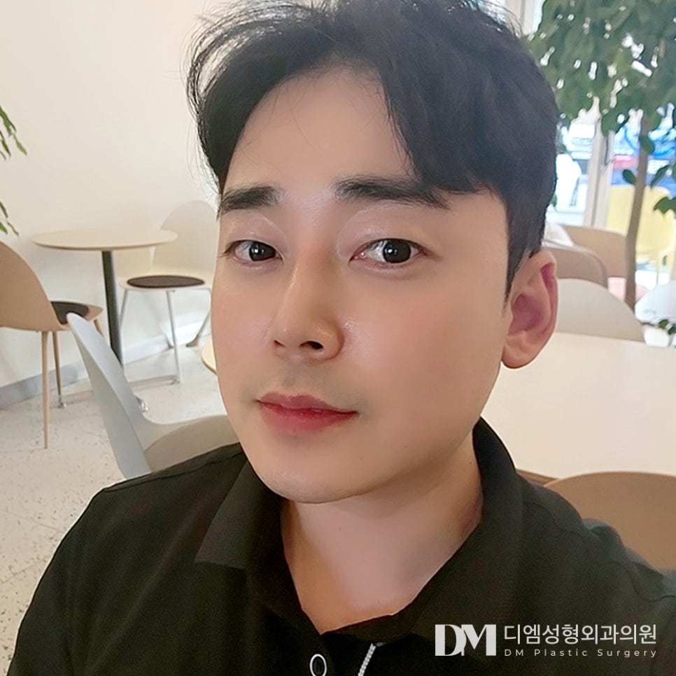 디엠 남자눈성형 전후사진, 부담스럽지 않게 또렷해지는 비결은? 관련 이미지 3