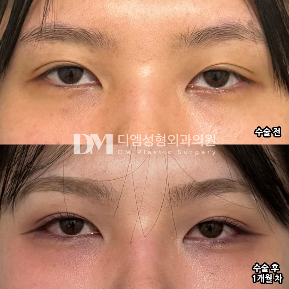 Ppang-tteum Review. “I’m so satisfied that the result came out with exactly the natural look I wanted” image 2