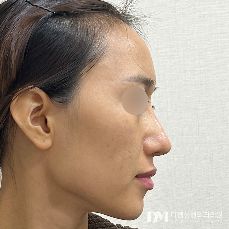 DM Long Nose Surgery: No More Midface Proportions Stress! image 6