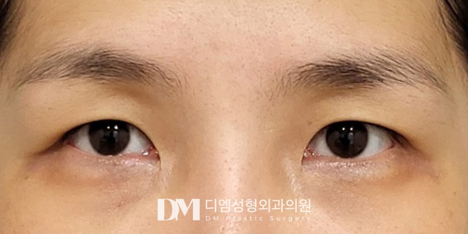 처지고 덮힌 눈매가 고민인 중년 모이세요 ! 관련 이미지 9