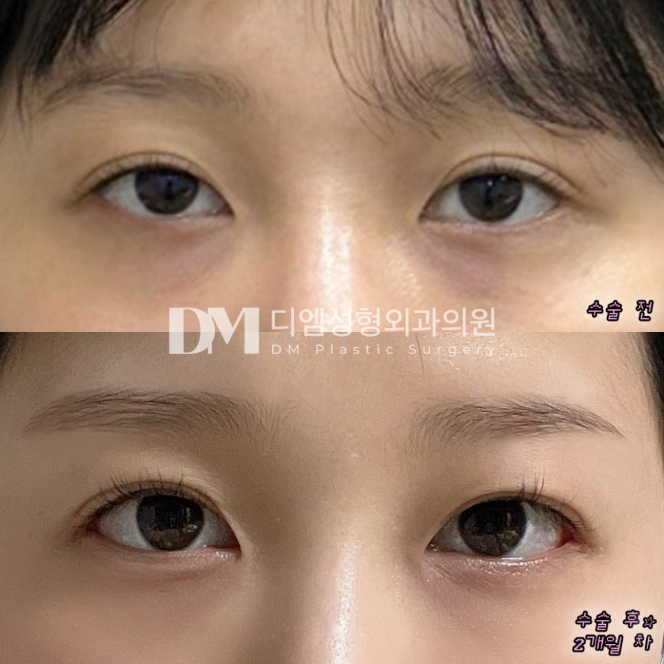 Can Outer- and Lower-Eye Corner Surgery Improve Both Your Impression and Eye Shape? image 5
