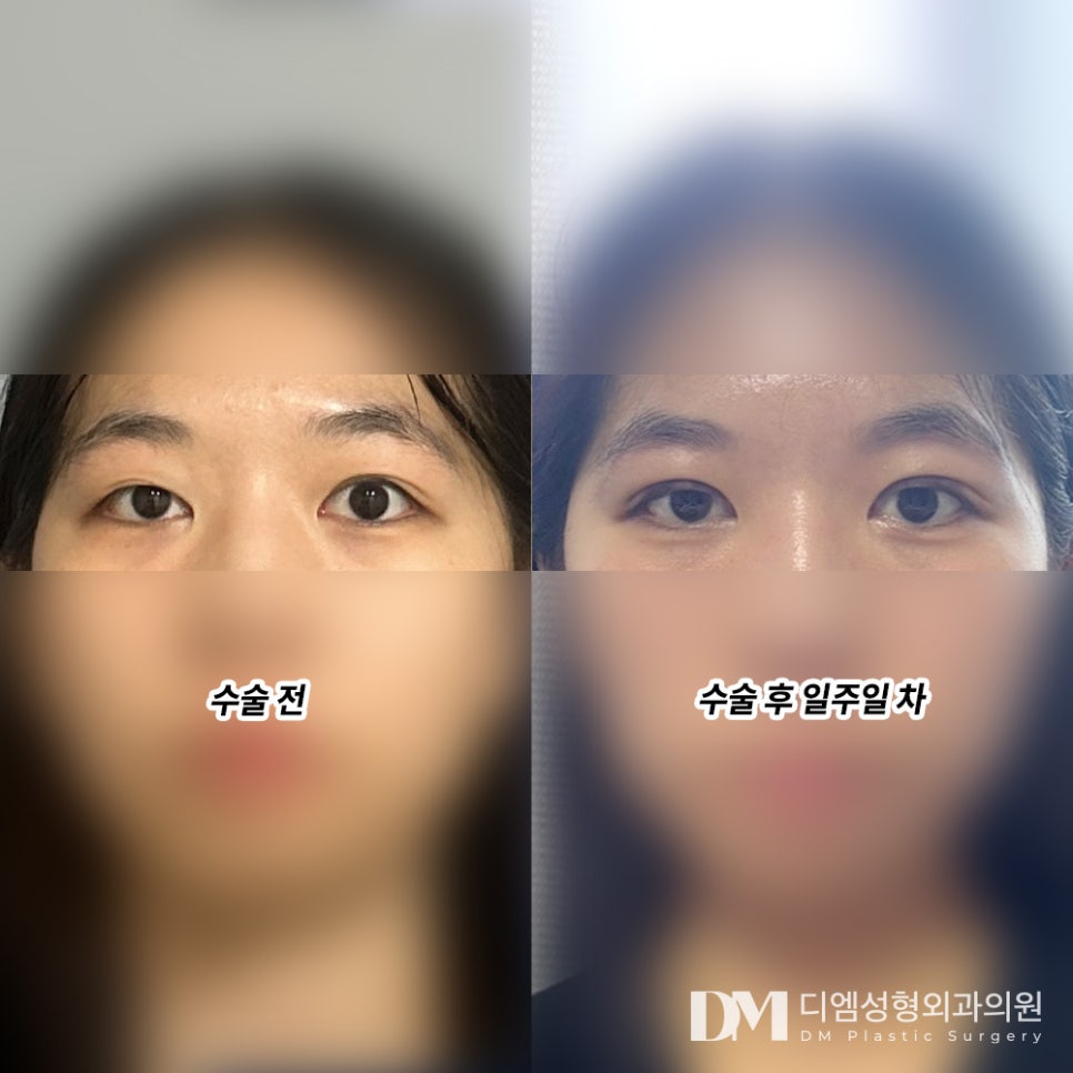 눈재수술 후기."일상생활에 큰 지장 없었고, 부작용도 전혀 없어서 만족스러웠어요" 관련 이미지 2