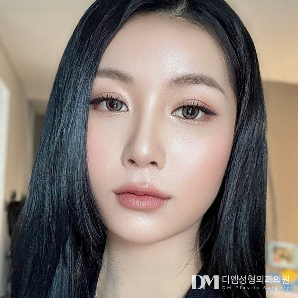 눈재수술 종착지 디엠 ! 관련 이미지 1