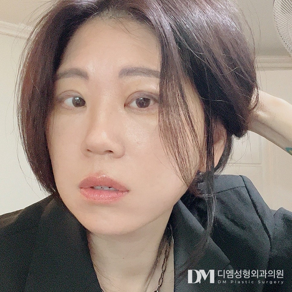 안면거상, 힘없이 늘어진 피부가 고민이라면 관련 이미지 10