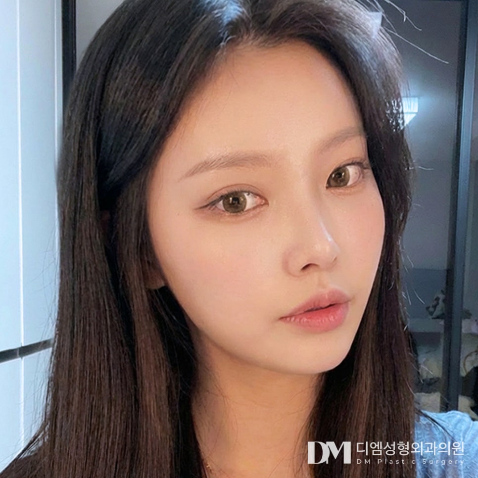 디엠 뒤밑트임 전후사진, 선하고 시원해진 눈매의 비결은? 관련 이미지 3