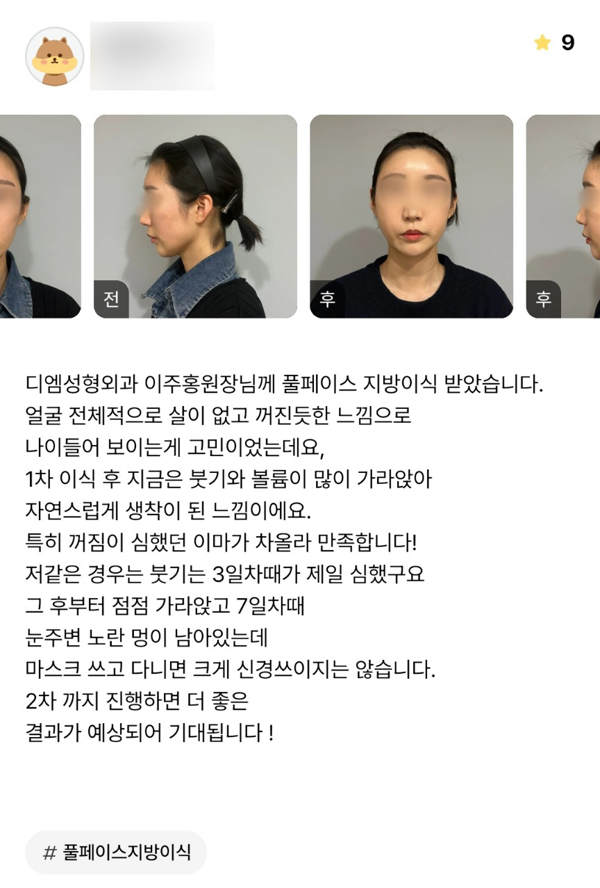 Facial Fat Grafting Review: “I’m Especially Satisfied That My Deeply Sunken Forehead Has Filled Out!” image 1