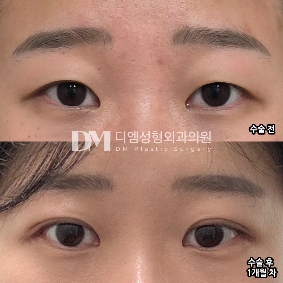 디엠 눈재수술/빵트임 수술후기, “전체적으로 만족합니다!” 관련 이미지 2