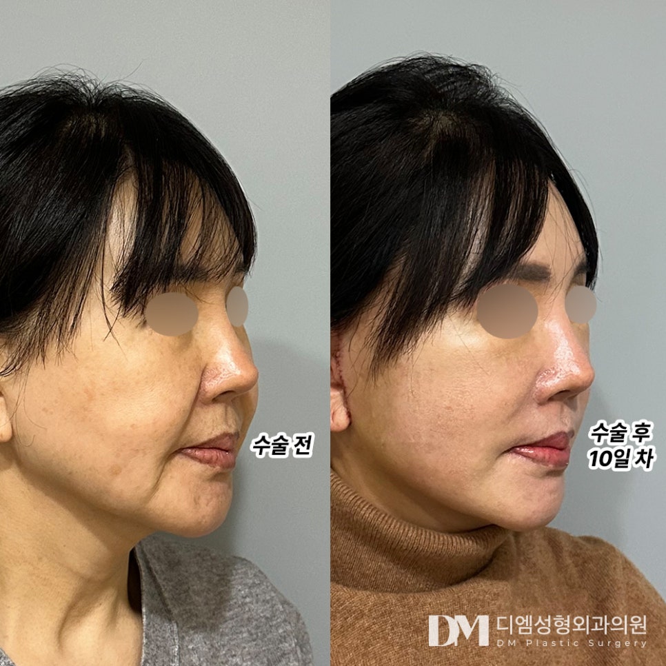 Facelift: Saving My Skin That Has Lost Elasticity and Become Saggy image 6