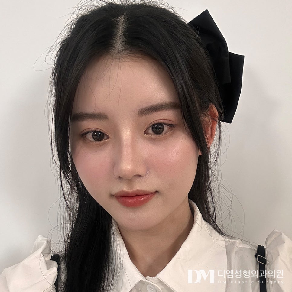 짧은코 성형, 전체적인 얼굴 조화를 고려해 자연스럽게 ! 관련 이미지 1