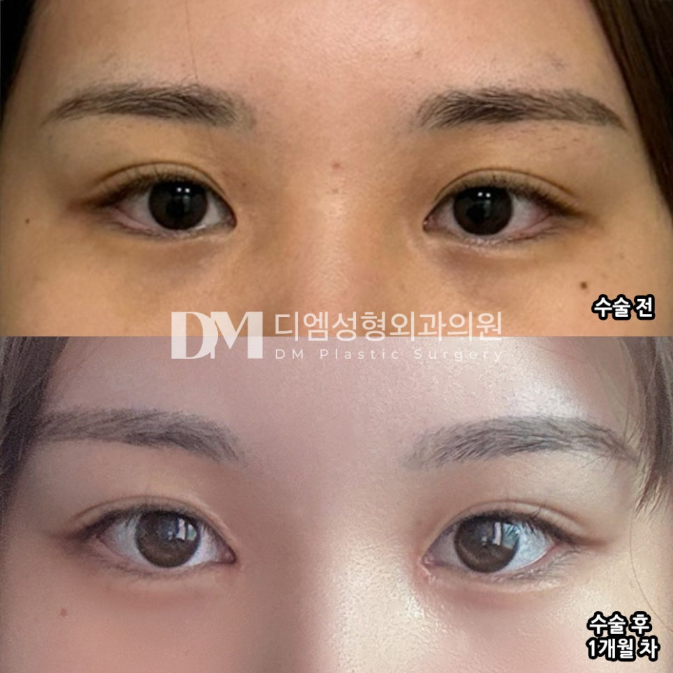 눈재수술 후기."눈이 시원하게 트이고 싶다면 여길 추천 드립니다 !" 관련 이미지 2