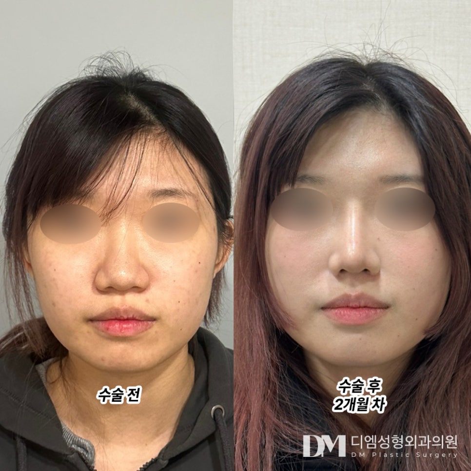 복코성형 , 얼굴의 균형과 조화를 맞춰 관련 이미지 10