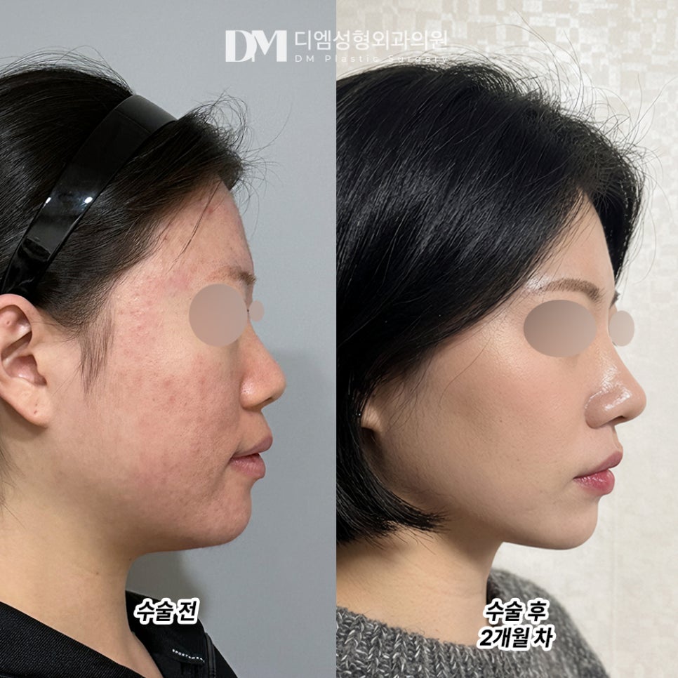 디엠 코성형 후기, “자연스럽게 콧대가 높아진 거 같아서 만족합니다!” 관련 이미지 2