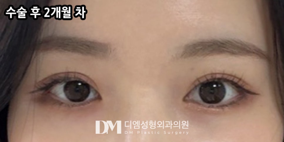 Ppangteuim: If You Want Larger, More Open-Looking Eyes?! image 6
