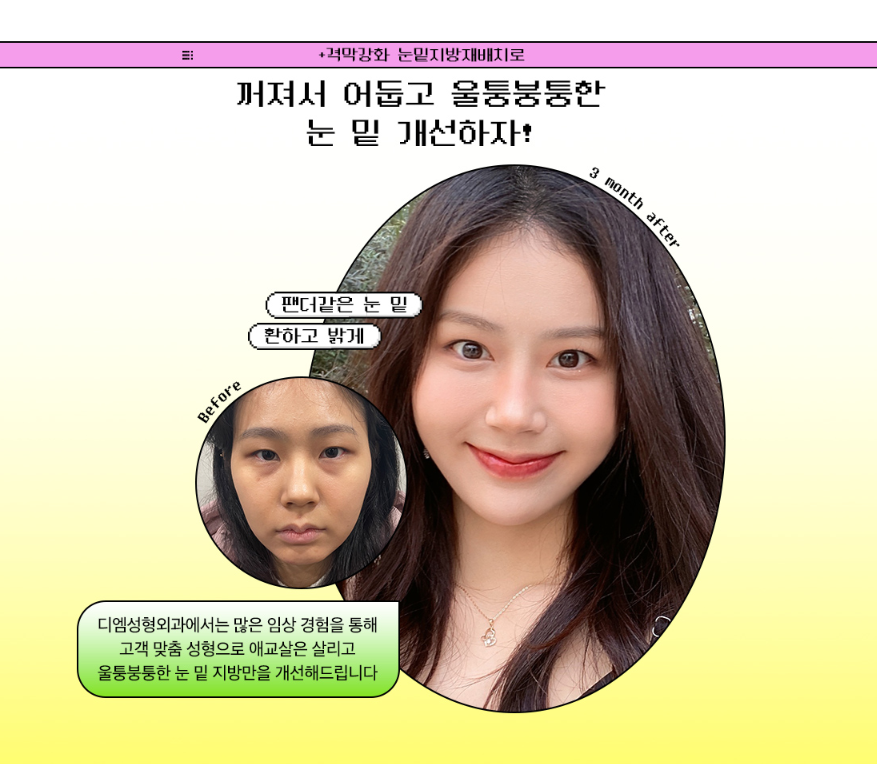눈밑지방재배치, 노안 이미지와 피곤한 인상이 고민이라면 관련 이미지 2