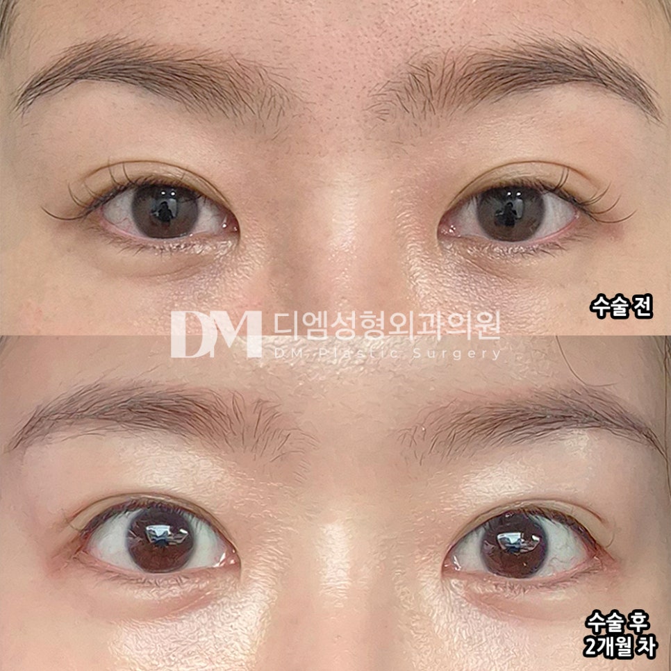DM Lateral and Lower Canthoplasty Review, “I’m Very Satisfied Because It Settled in So Naturally!” image 2