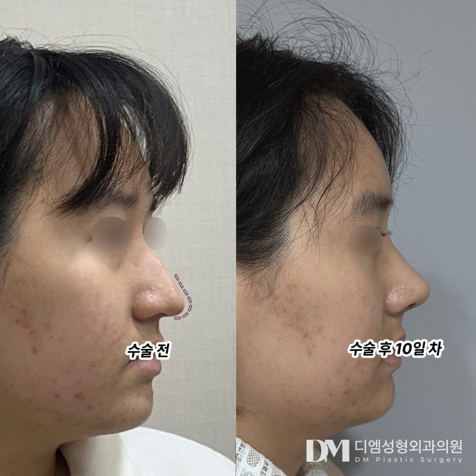 Arrow Nose Surgery: Change Your Impression with a Neater Nose Tip! image 6