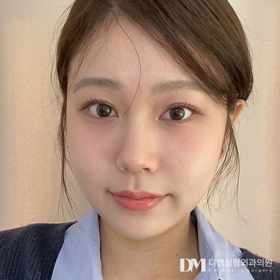 눈밑지방재배치, 안와격막 고정이 중요한 이유는? 관련 이미지 1