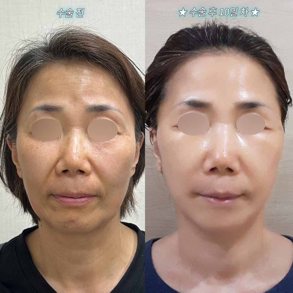 안면거상 후기."얼굴 라인이 확실히 갸름해져서 만족하고 있어요." 관련 이미지 2