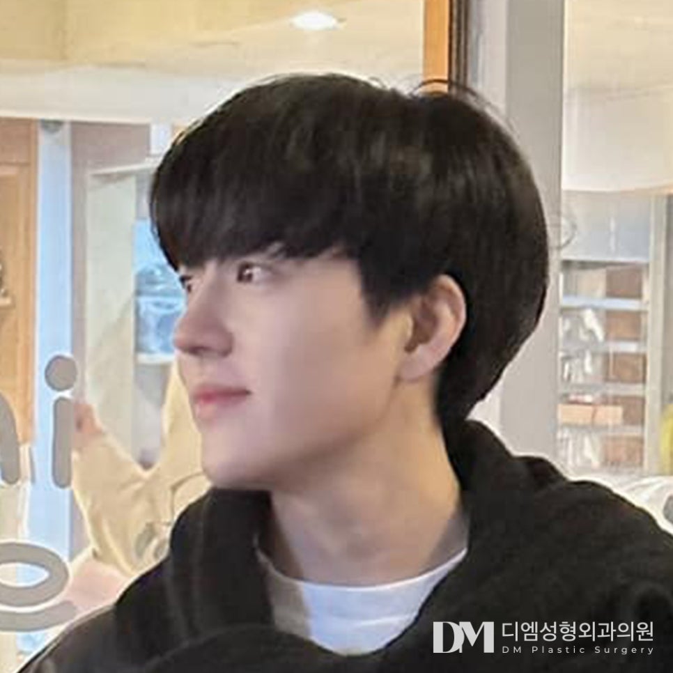 짧고 처진 코 끝, 이목구비에 맞게 개선하려면? 관련 이미지 1