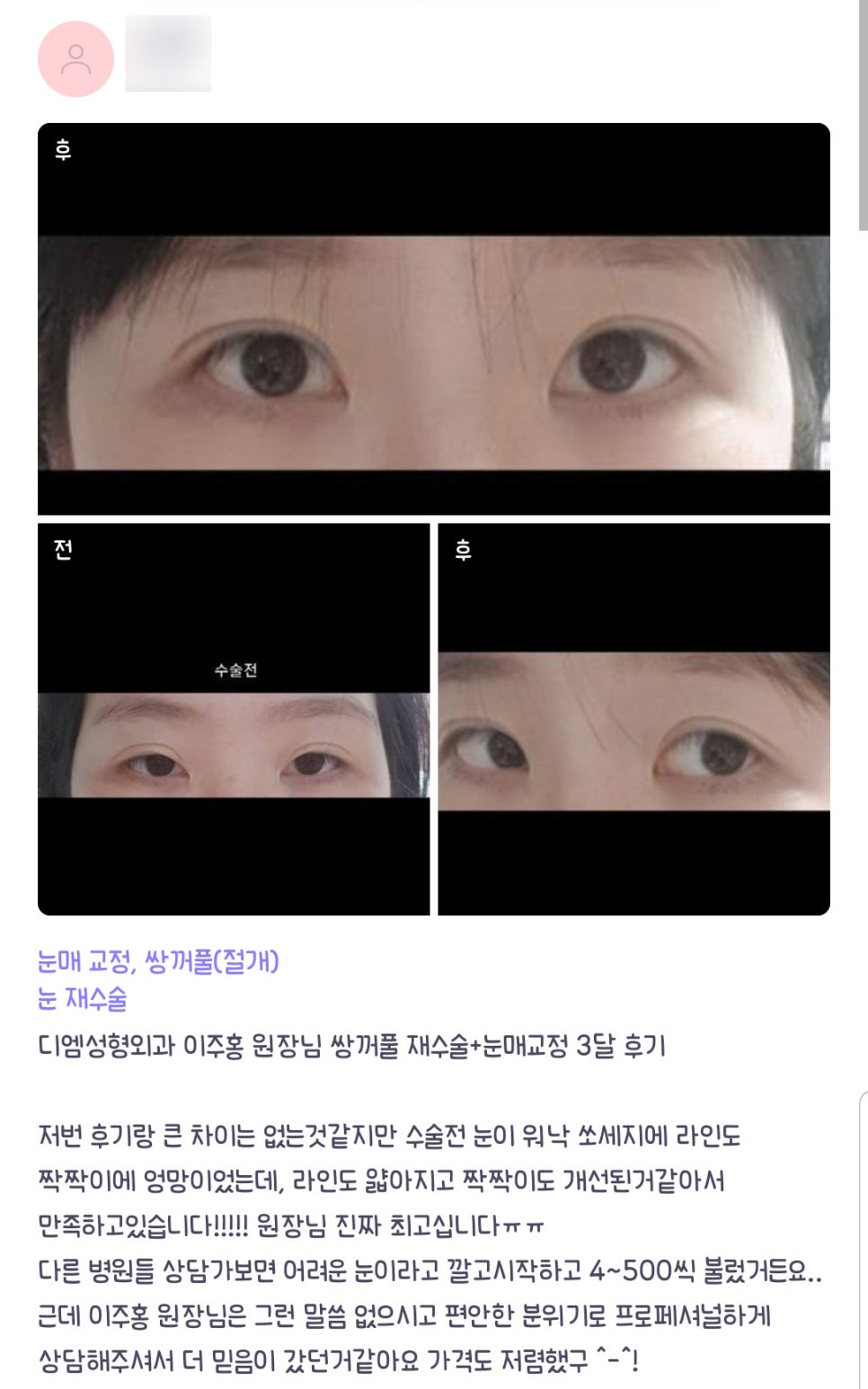 눈재수술 후기."고민이던 부분이 다 개선된 것 같아서 만족입니다!" 관련 이미지 1