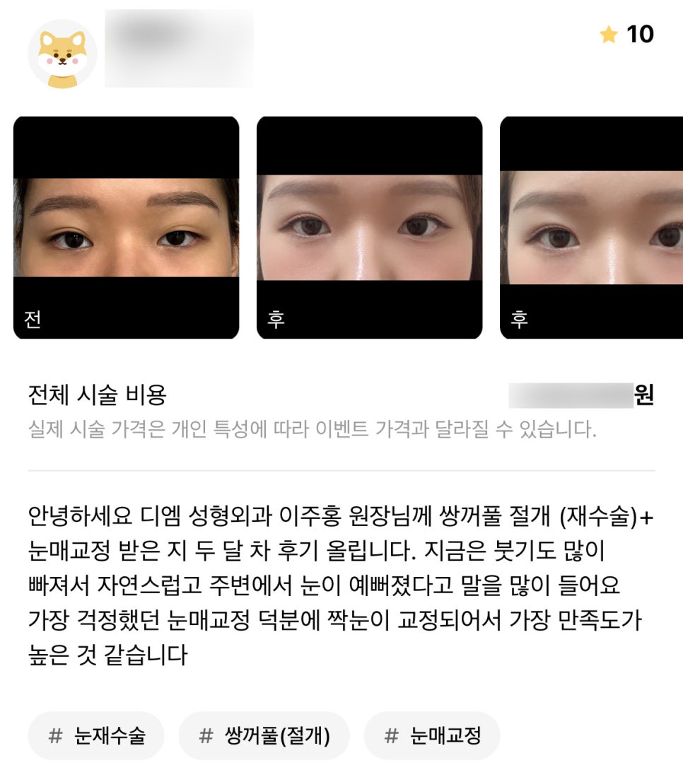 눈재수술 후기."주변에서 눈이 예뻐졌다고 말을 많이 들어요!" 관련 이미지 1