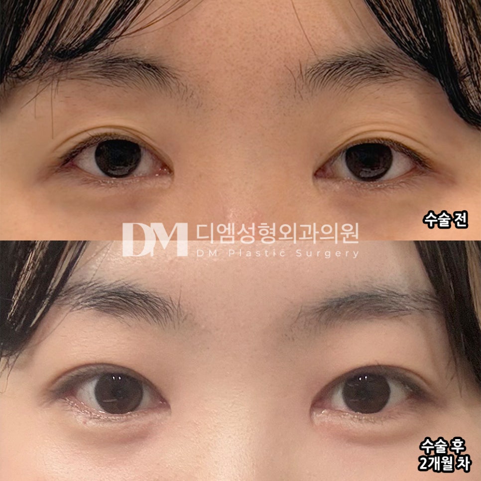 디엠 눈재수술 전후사진, 더 이상 실패하지 않으려면! 관련 이미지 2
