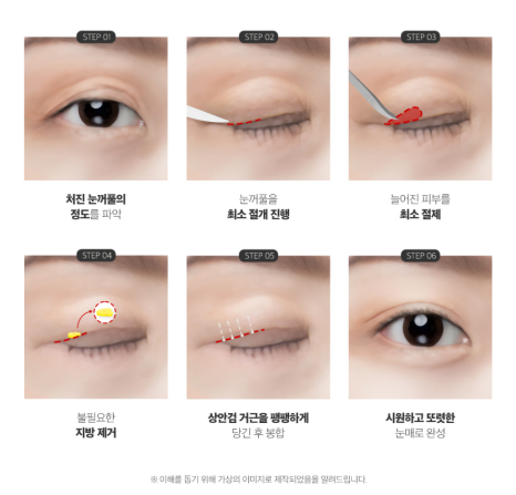 Improving Droopy Eyes with Upper Blepharoplasty image 7