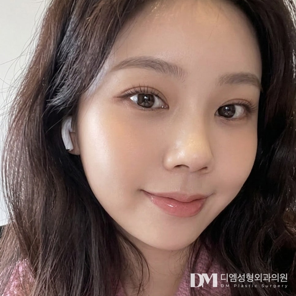Before-and-After Photos of DM Lateral and Lower Canthoplasty: What’s the Secret to Solving Concern About a Fierce, Heavy-Looking Eye Shape? image 3