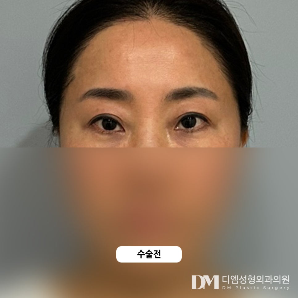 Forehead Lift for a Natural, Youthful Appearance! image 7