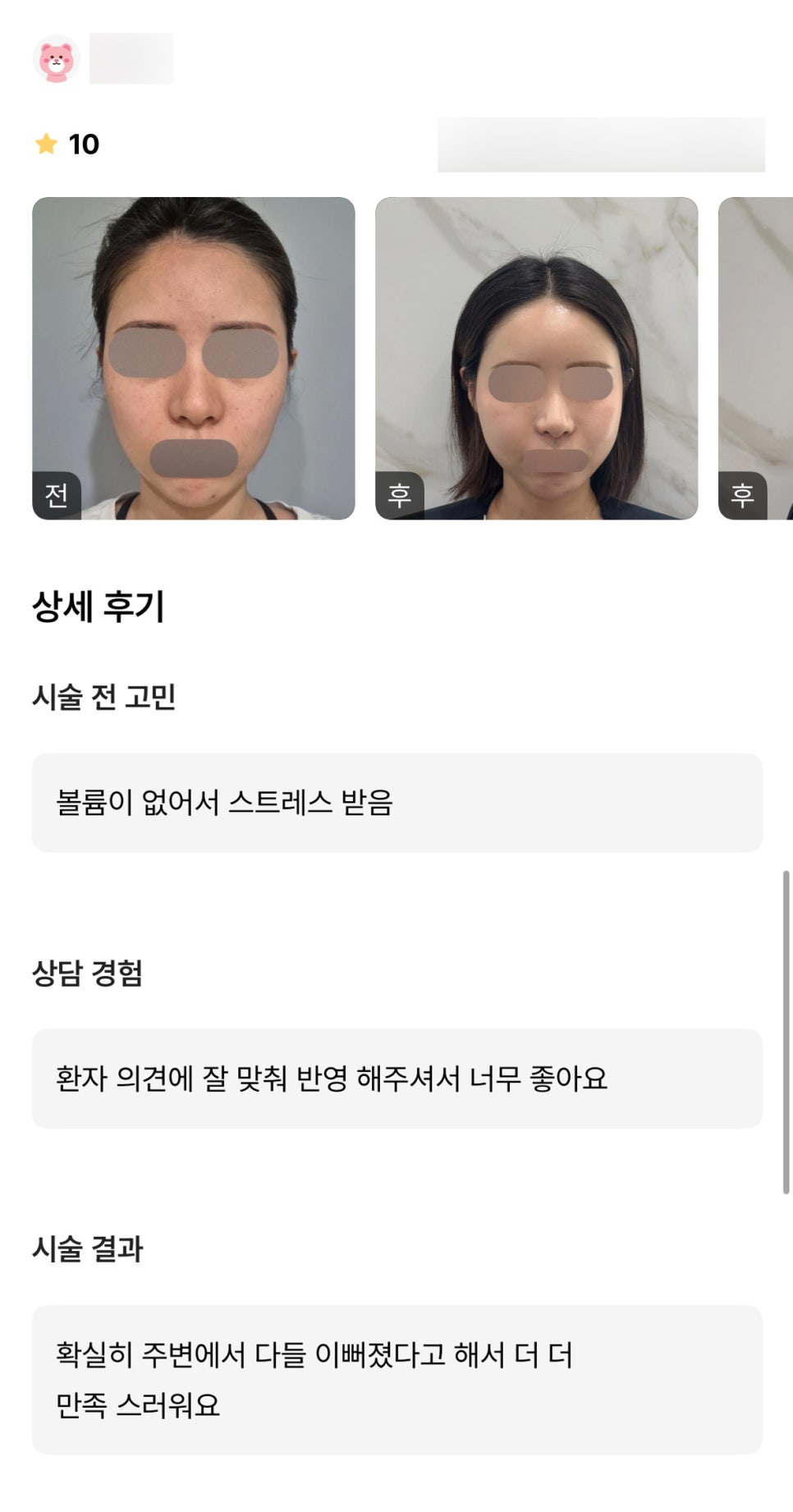 얼굴지방이식 후기." 다들 이뻐졌다고 해서 더 더 만족스러워요 !" 관련 이미지 1