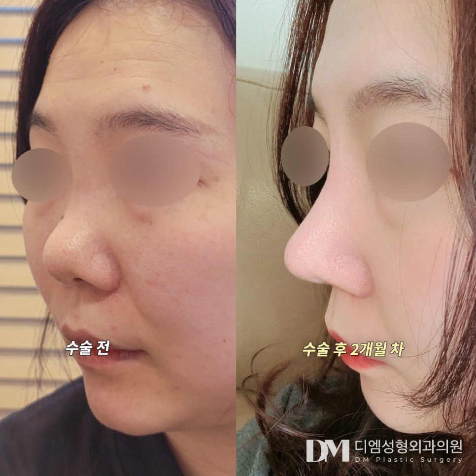 Short Nose Surgery: Worried Your Nose Is Too Short and Gives You a Frumpy Impression? image 8
