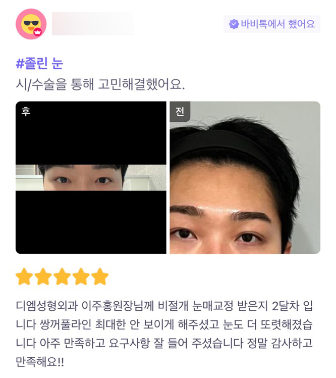 눈성형 후기."니즈파악을 잘해주셨고 눈도 더 또렷해졌어요!" 관련 이미지 1