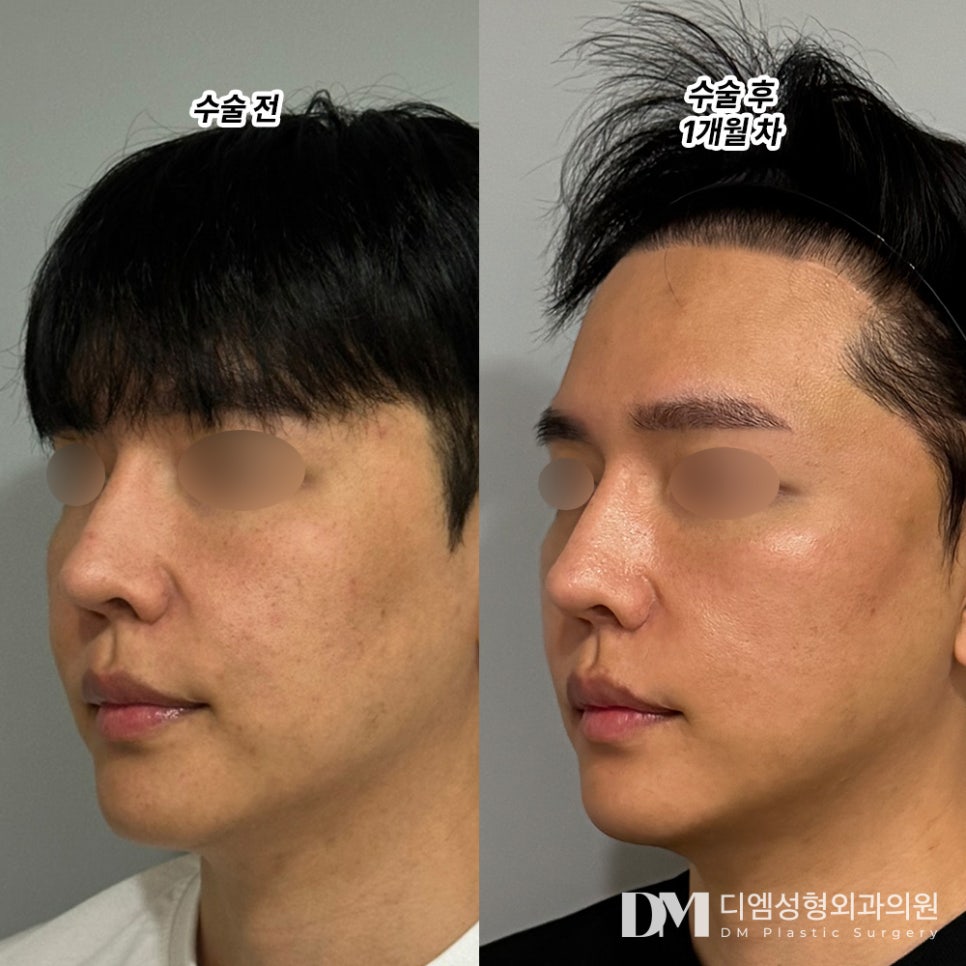 If Half Facelift or Facelift Scars Feel Burdensome image 7