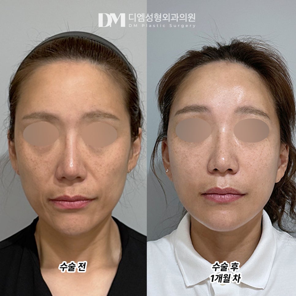 디엠 안면거상 전후사진, 잃어버린 젊음을 다시 찾다! 관련 이미지 2