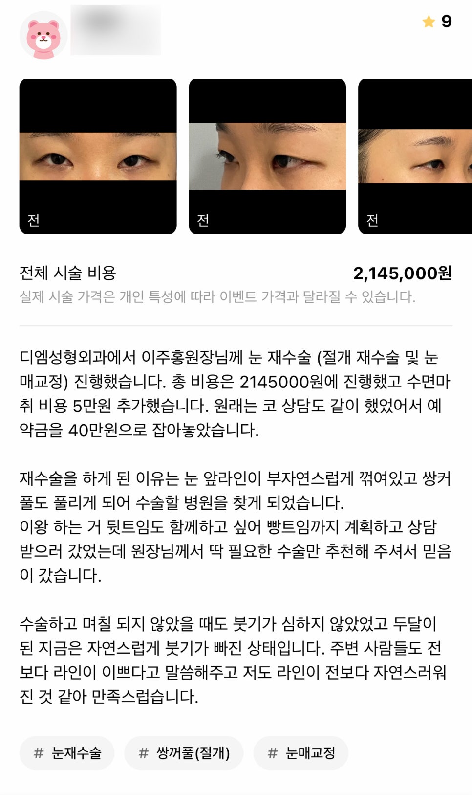 Revision Eyelid Surgery Review: “I’m satisfied because it looks more natural than before!” image 1