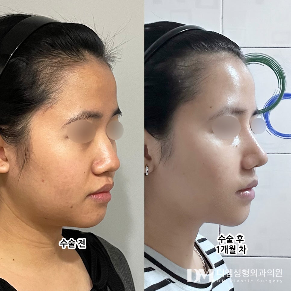 Tip Rhinoplasty: Moving Away from a Bulky, Unsophisticated Look! image 8