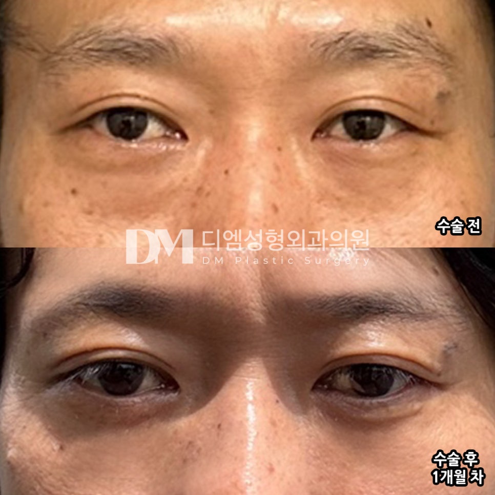 눈밑지방재배치 후기."바로 효과가 보여서 매우 만족입니다!" 관련 이미지 2