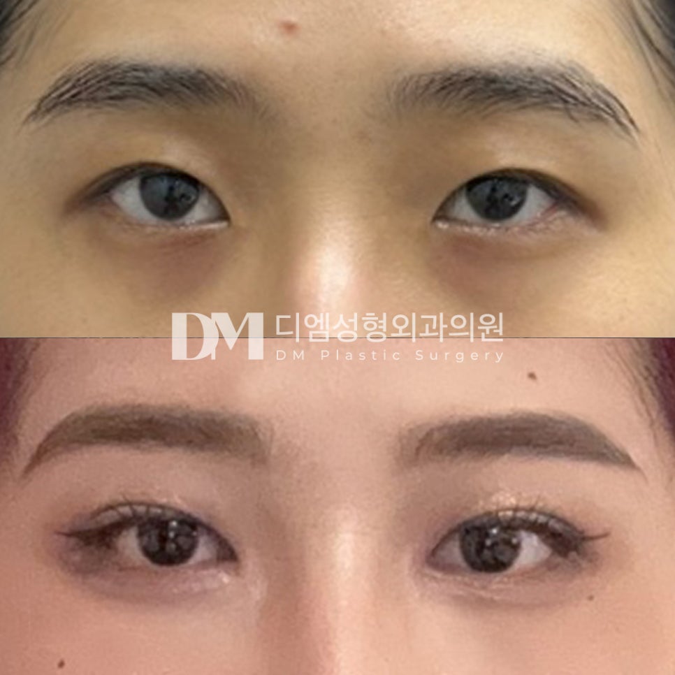 눈성형 후기." 전보다 확실히 눈이 커졌는데 수술한거 같지는 않다고들 하네요" 관련 이미지 2