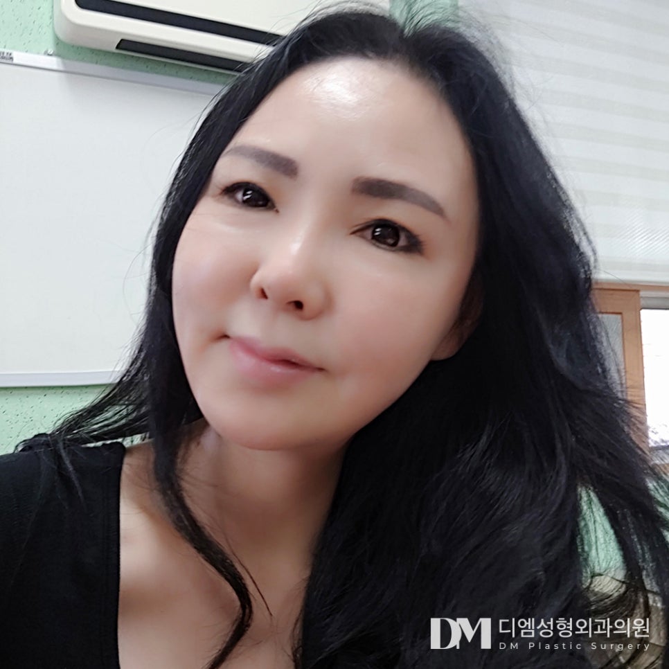 Forehead Lift, Improving Forehead Wrinkles and Crow’s Feet at the Same Time image 10