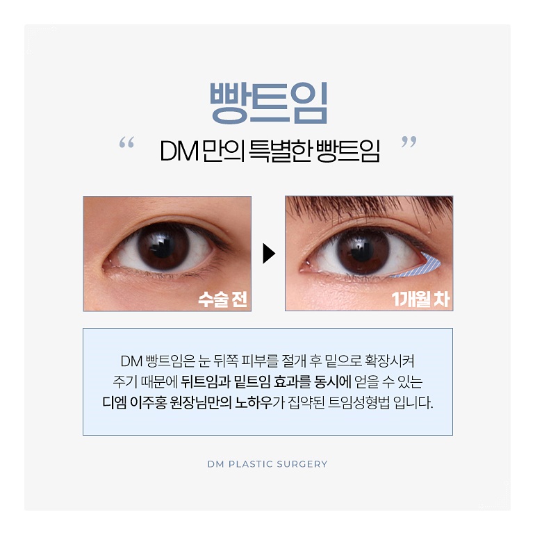 뒤밑트임, 흉터없이 순한 눈매로 관련 이미지 4