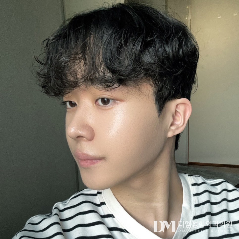 얼굴지방이식 , 볼륨감을 채워 조화로운 얼굴로 관련 이미지 1