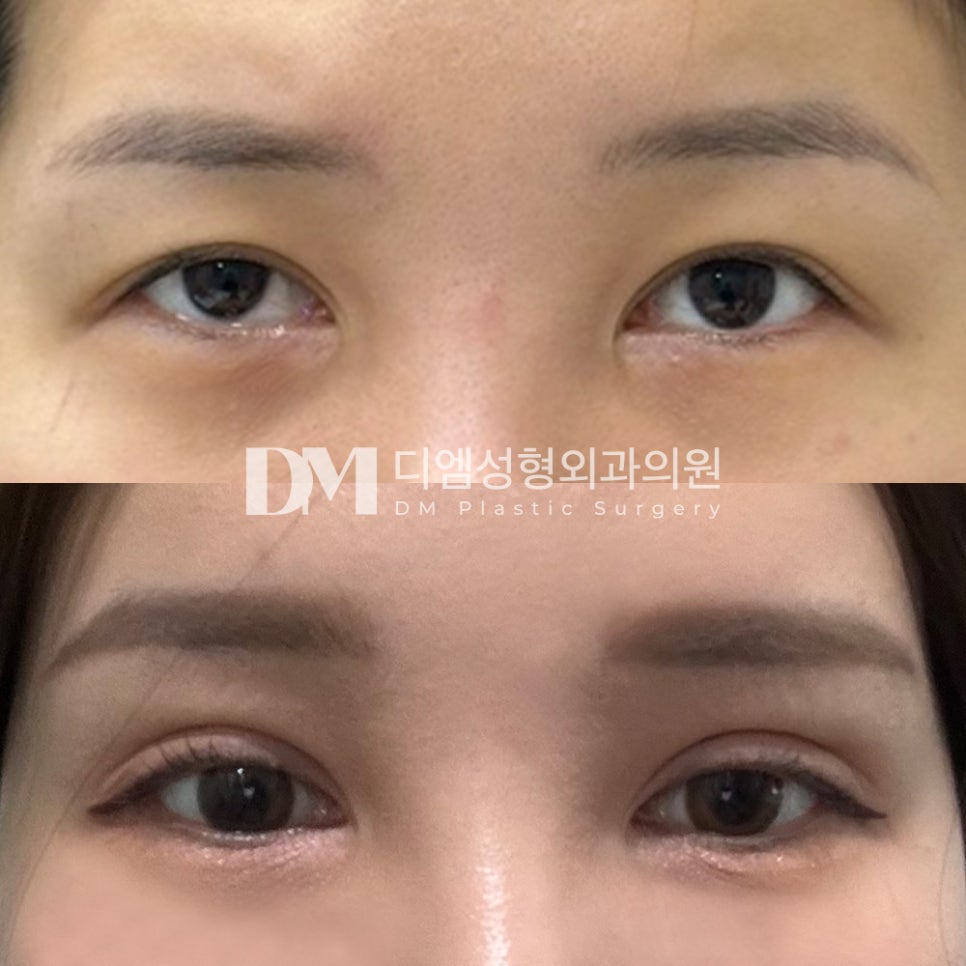 눈성형 후기."붓기도 많이빠졌고 라인도 자리잡아가는 것 같아요!" 관련 이미지 2