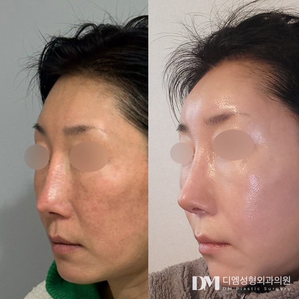 Revision Rhinoplasty Review: “The Shape of My Nose Turned Out So Well!” image 2