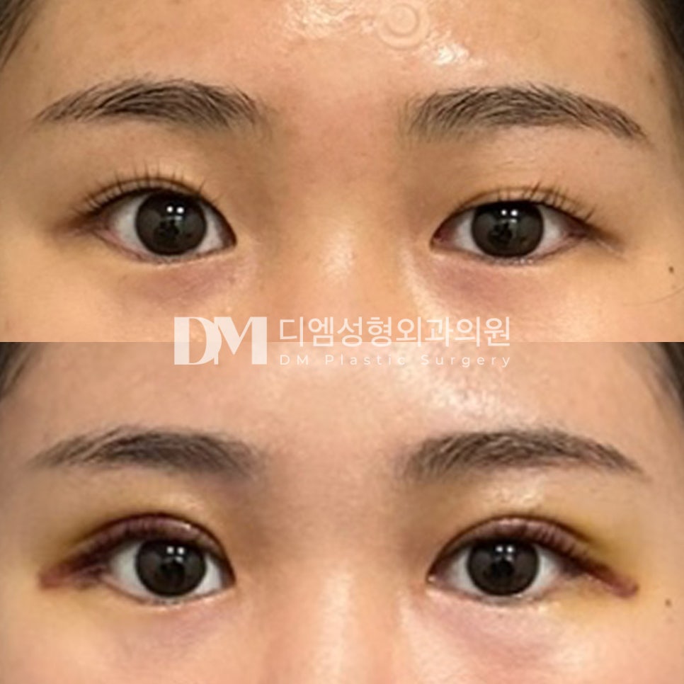 Revision Eye Surgery Review: “I’m looking forward to seeing how pretty it will look once the swelling goes down!” image 2