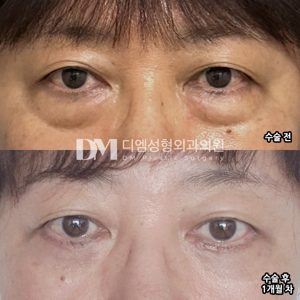 노화로 인한 불룩한 눈밑, 하안검으로 ! 관련 이미지 7