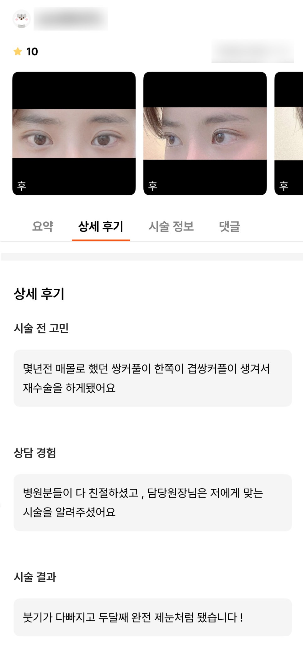 눈재수술 후기."완전 제 눈처럼 됐어요!" 관련 이미지 1