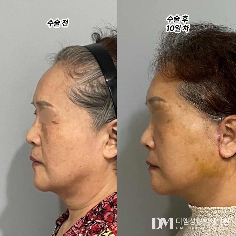 안면거상, 축 처져 우울해보이는 인상 팽팽하게 개선하기 관련 이미지 6
