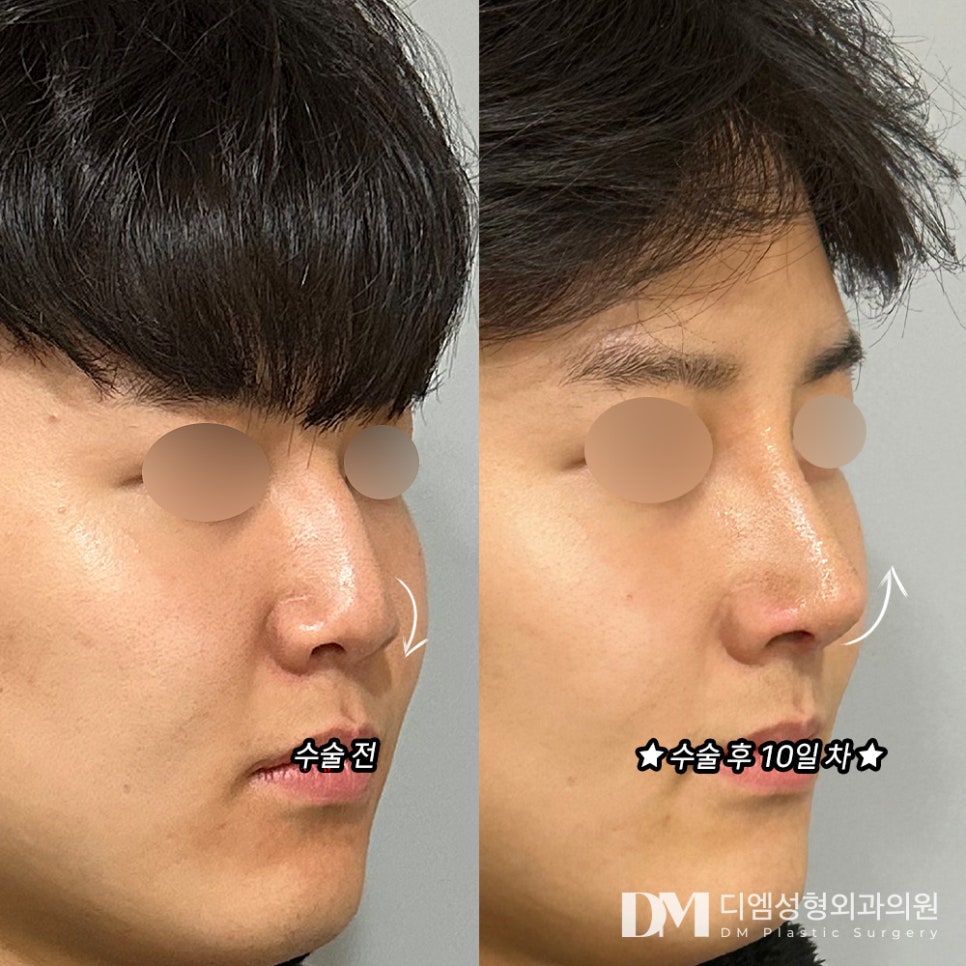 짧고 처진 코 끝, 이목구비에 맞게 개선하려면? 관련 이미지 8
