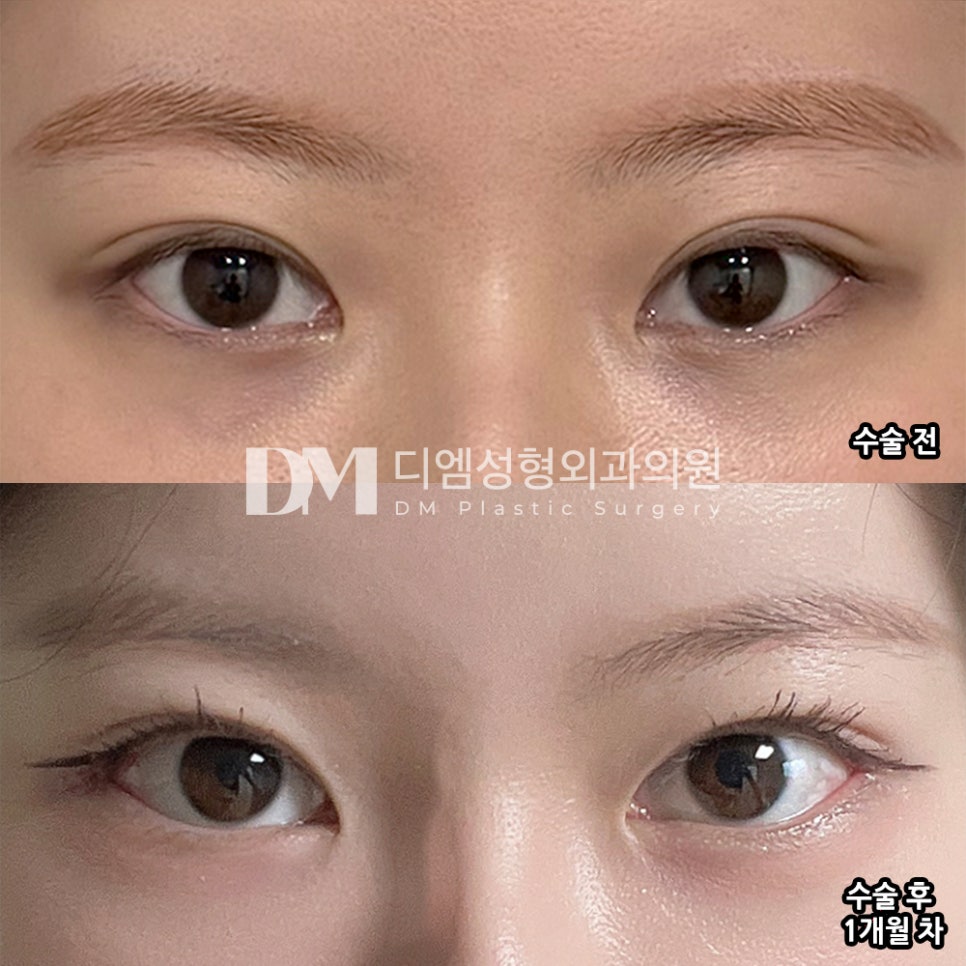 DM Lateral and Lower Canthoplasty Surgery Review, &ldquo;I’m Leaving DM After Resolving My Insecurity!&rdquo; image 2
