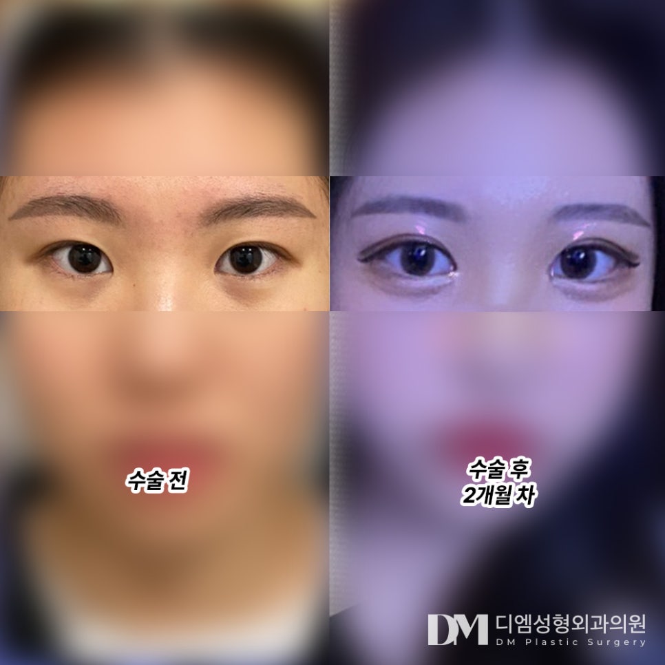 눈성형 후기."자연스럽고 만족해용 ❤" 관련 이미지 2